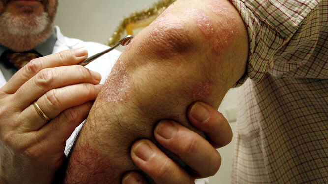 Detalle de la piel de una persona con psoriasis.