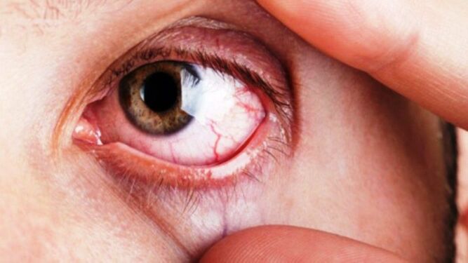 El glaucoma suele aparecer a partir de los 40 años de edad.
