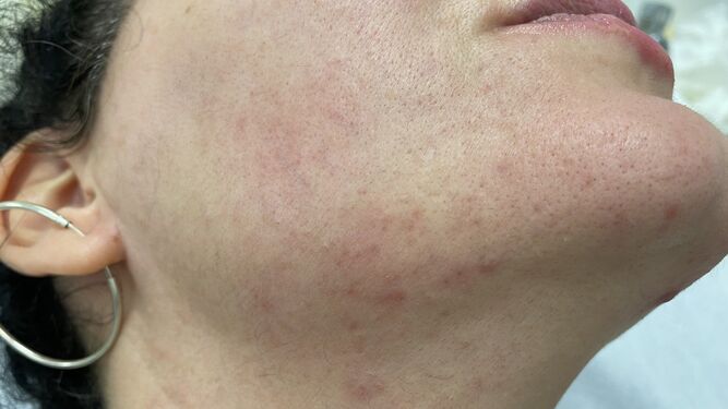 Apreciación del Maskné, dermatitis facial por efecto de la mascarilla.
