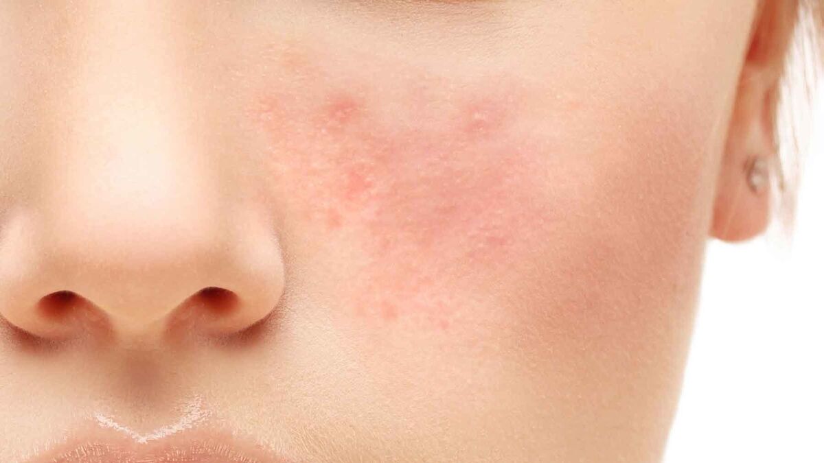 Dar No de moda nombre Alergia y agravamiento del acné y la rosácea, entre los problemas en la piel  por mascarillas y geles hidroalcohólicos