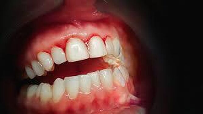 La bacterias bucales son la principal causa de periodontitis, una de las principales causas de la pérdida de dientes