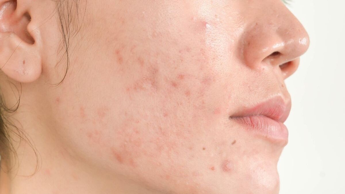 Muñeco de peluche Destilar Absorbente 5 remedios caseros para combatir el acné