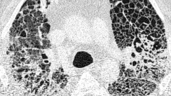 Un estudio muestra el destrozo del covid grave en los pulmones