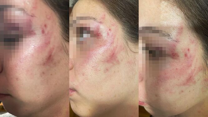 Las lesiones provocadas por la agresión en el rostro de la joven.