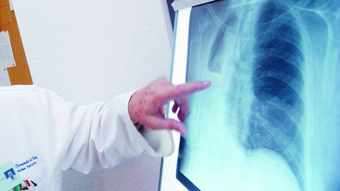 Un doctor examina una radiografía de los pulmones