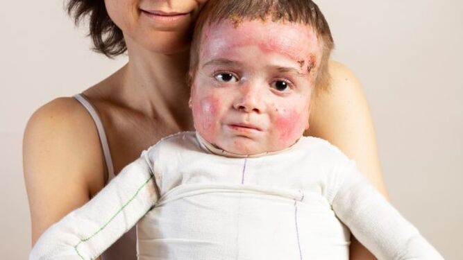 Curan por primera vez las heridas en la piel de ''niños mariposa'' a través de una terapia génica