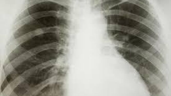 Radiografía a un cáncer de pulmón