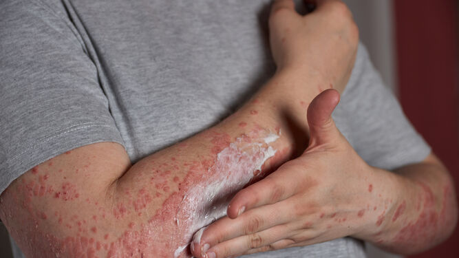 Una persona con psoriasis se aplica crema sobre la piel.