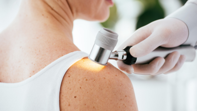 ¿Se puede prevenir el melanoma en verano?