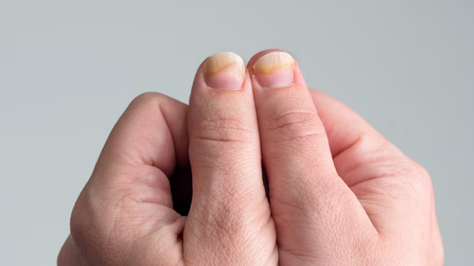 Onicolisis, cuando tus uñas dicen adiós: Uno de los efectos secundarios más graves de los esmaltes permanentes