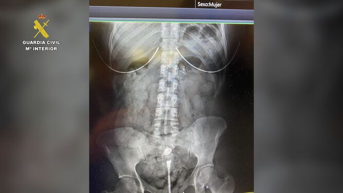 Radiografía de una de las personas detenidas con algunas bellotas de hachís dentro de su cuerpo.