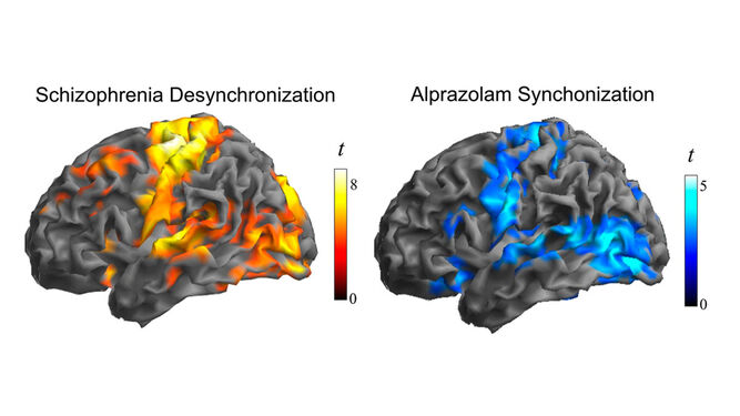 Imagen que muestra la similitud entre las áreas afectadas en el cerebro de una persona con esquizofrenia (izq.) y las áreas donde se concentran las neuronas estudiadas (dcha.).