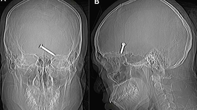 Radiografía realizada al hombre con el clavo en el cráneo